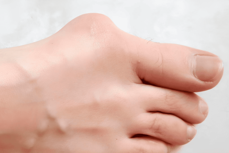 joanete-e-dedo-em-martelo